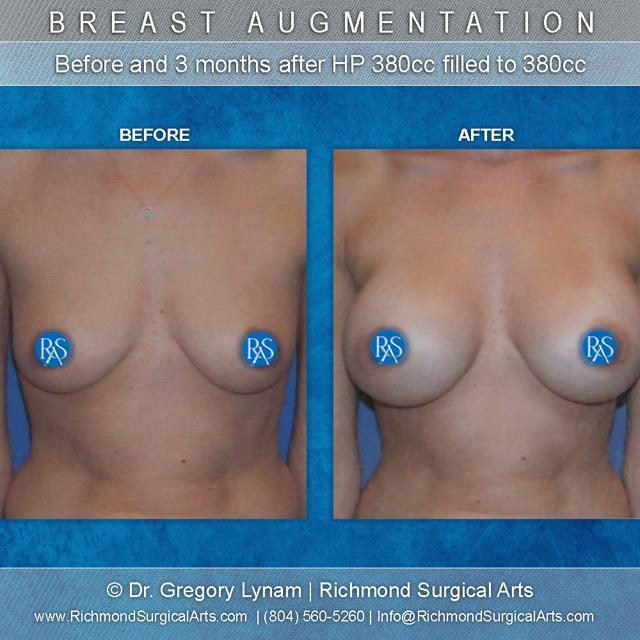 Breast Augmentation result at Richmond Surgical Arts in Richmond, VA