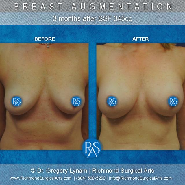 Breast Augmentation result at Richmond Surgical Arts in Richmond, VA