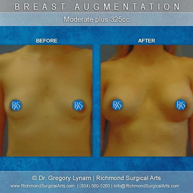 Breast Augmentation result at Richmond Surgical Arts in Richmond, VA