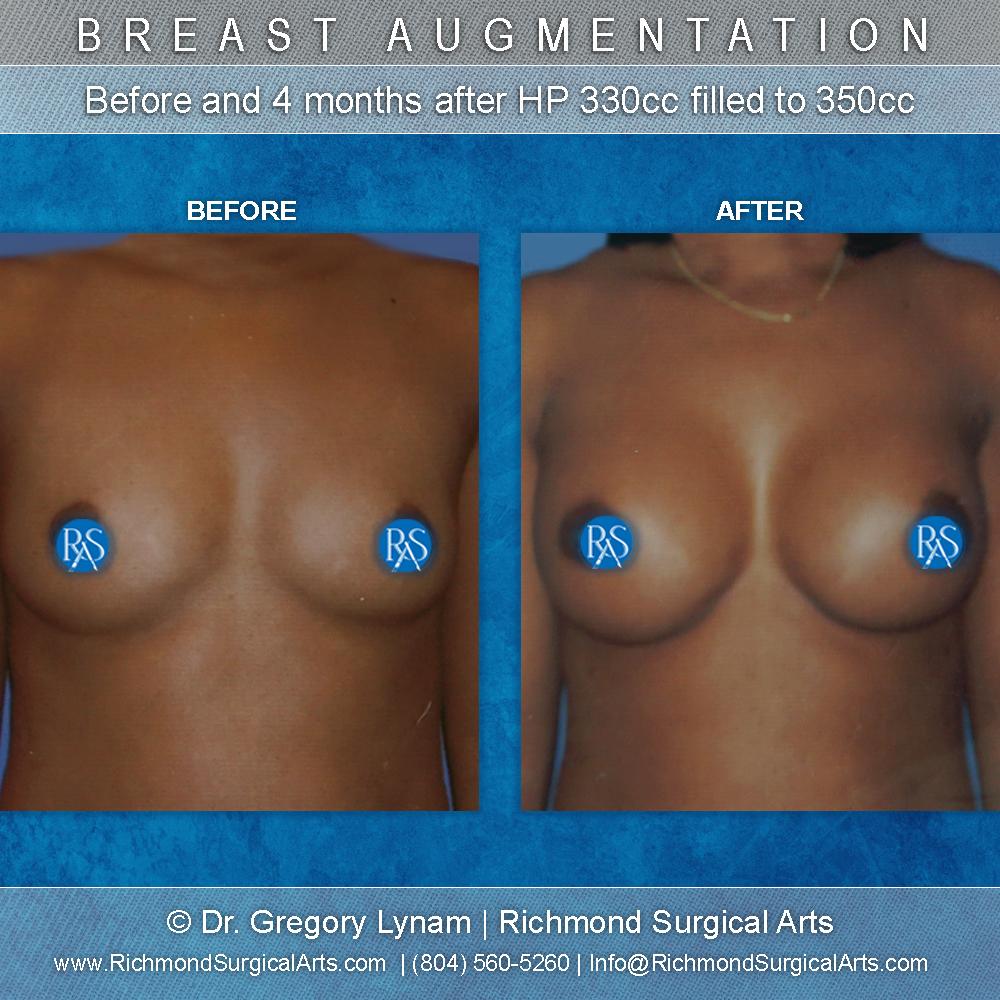 Richmond Surgical Arts breast augmentation result — Richmond, VA