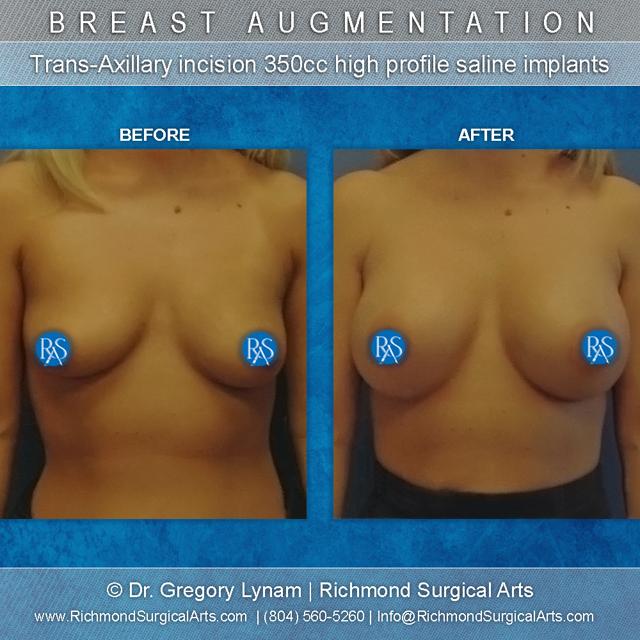 Breast Augmentation result at Richmond Surgical Arts in Richmond, VA