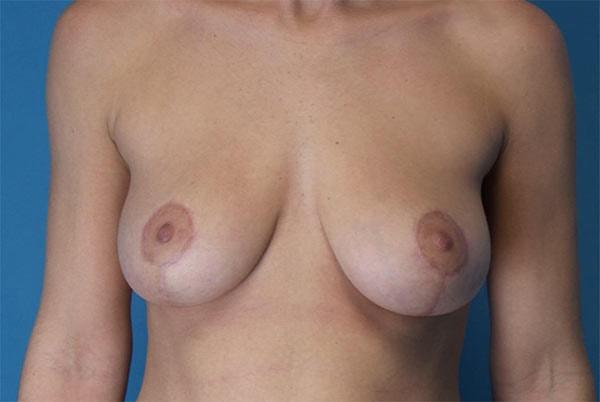 David B. Brothers, MD breast lift after — Atlanta, GA