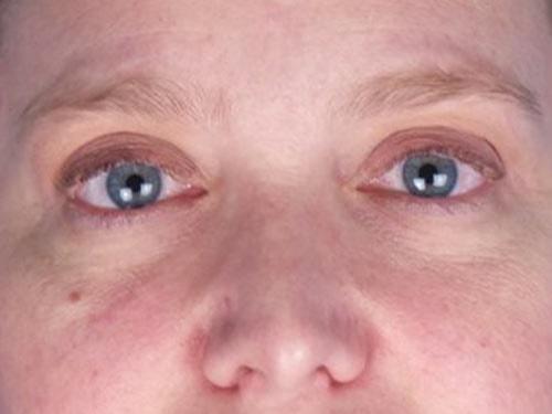David B. Brothers, MD eyelid lift after — Atlanta, GA