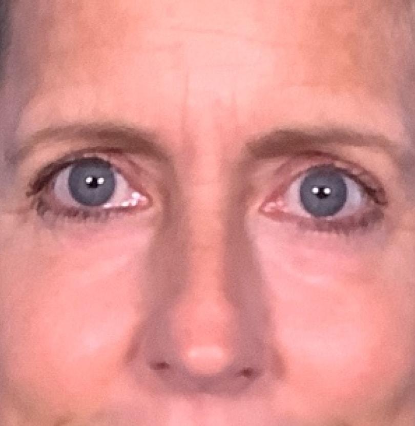 David B. Brothers, MD eyelid lift after — Atlanta, GA