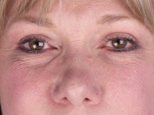 David B. Brothers, MD eyelid lift after — Atlanta, GA