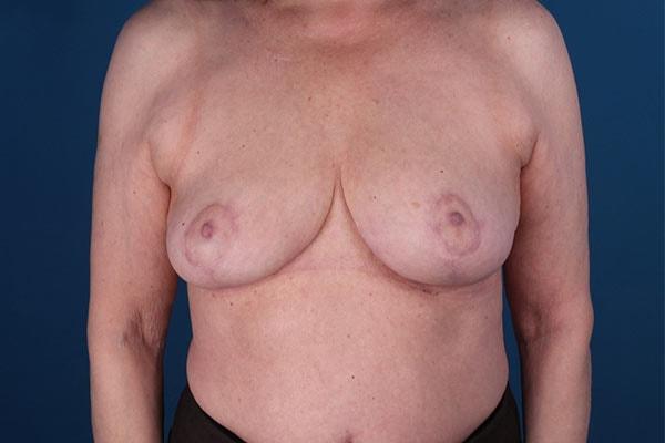 David B. Brothers, MD breast reduction after — Atlanta, GA