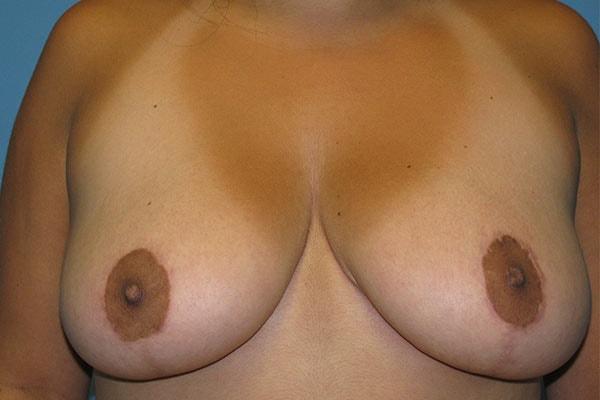 David B. Brothers, MD breast reduction after — Atlanta, GA