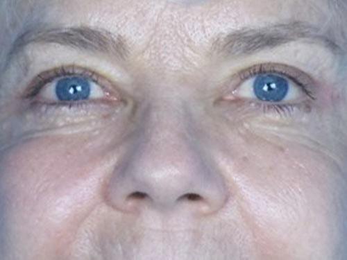 David B. Brothers, MD eyelid lift after — Atlanta, GA