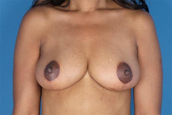 David B. Brothers, MD breast lift after — Atlanta, GA