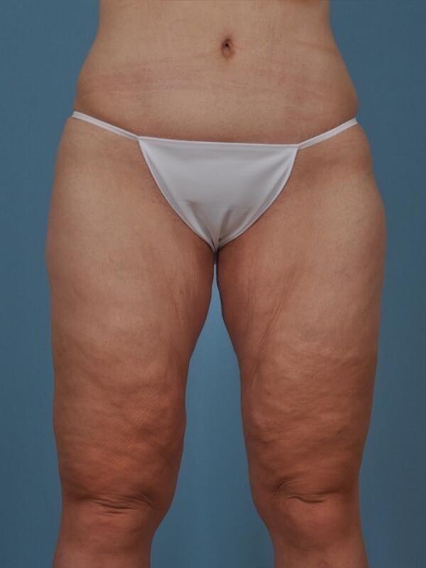 Thigh Lift before at StarkMD Plastic Surgery & Aesthetic Center in Bryn Mawr, PA