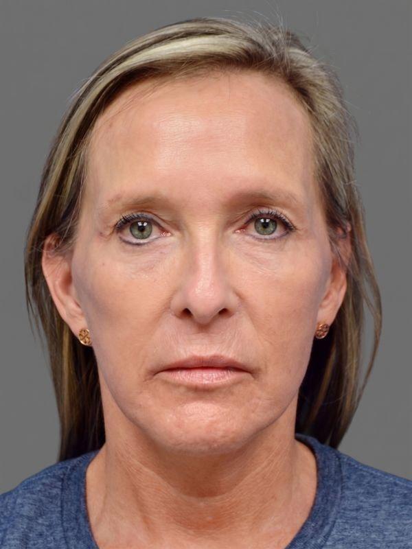 StarkMD Plastic Surgery & Aesthetic Center facelift after — Bryn Mawr, PA