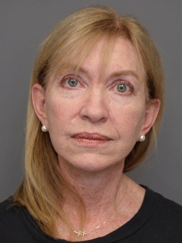 Deep Plane Facelift after at StarkMD Plastic Surgery & Aesthetic Center in Bryn Mawr, PA