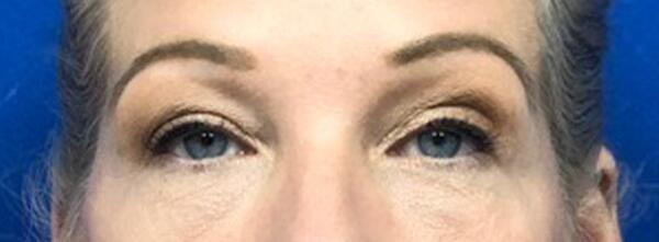 StarkMD Plastic Surgery & Aesthetic Center eyelid lift after — Bryn Mawr, PA