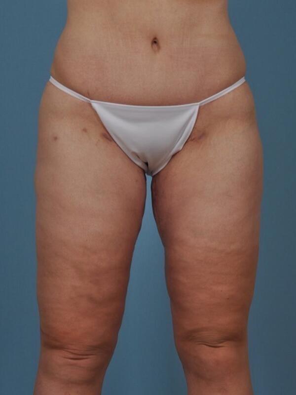 Thigh Lift after at StarkMD Plastic Surgery & Aesthetic Center in Bryn Mawr, PA