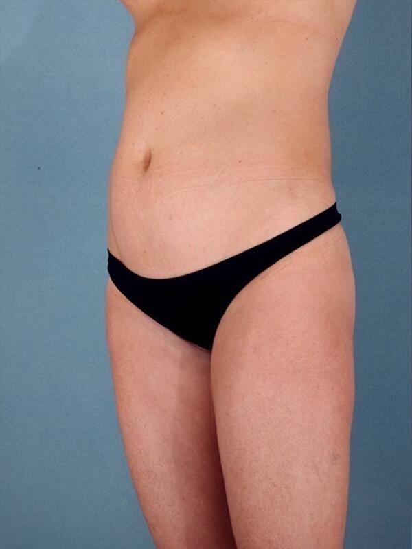 Liposuction before at StarkMD Plastic Surgery & Aesthetic Center in Bryn Mawr, PA
