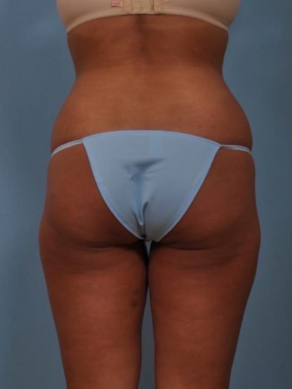 Brazilian Butt Lift before at StarkMD Plastic Surgery & Aesthetic Center in Bryn Mawr, PA