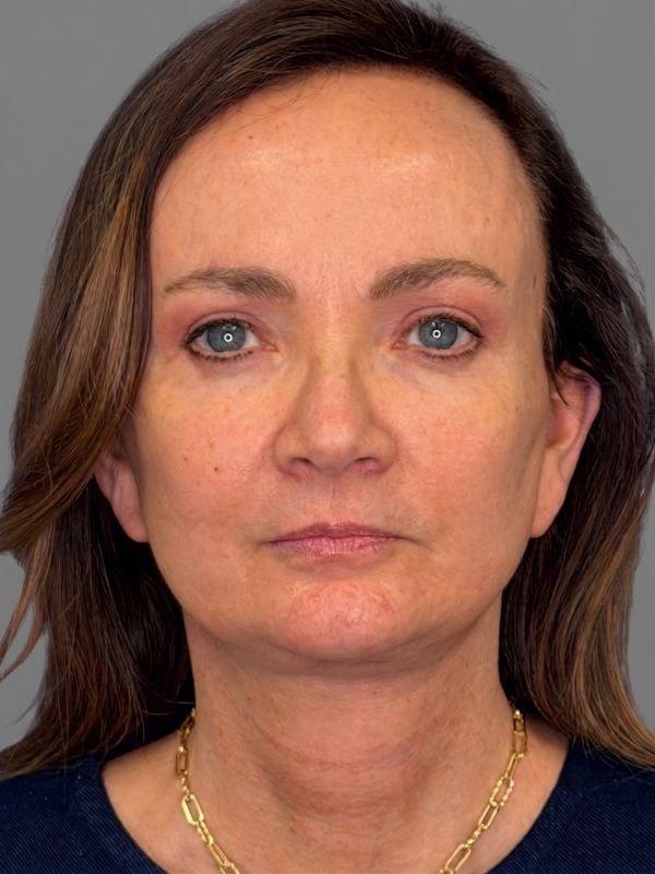 StarkMD Plastic Surgery & Aesthetic Center facelift after — Bryn Mawr, PA