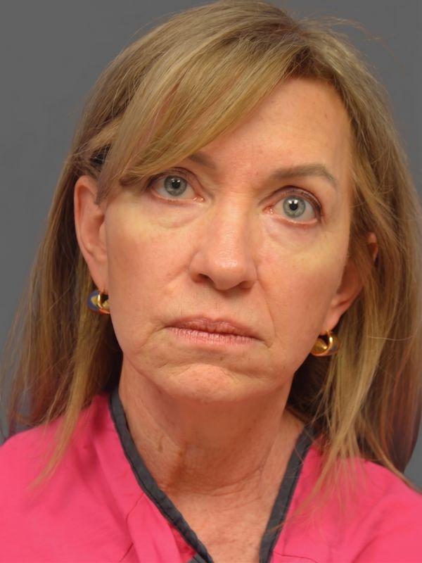 Deep Plane Facelift before at StarkMD Plastic Surgery & Aesthetic Center in Bryn Mawr, PA