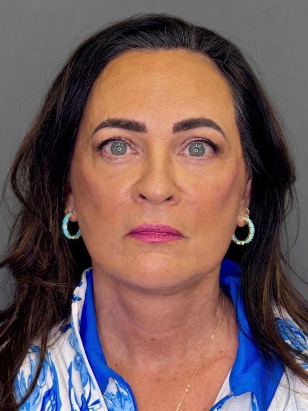 StarkMD Plastic Surgery & Aesthetic Center facelift after — Bryn Mawr, PA