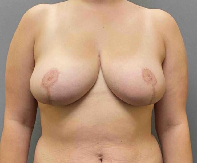 Breast Reduction after at StarkMD Plastic Surgery & Aesthetic Center in Bryn Mawr, PA