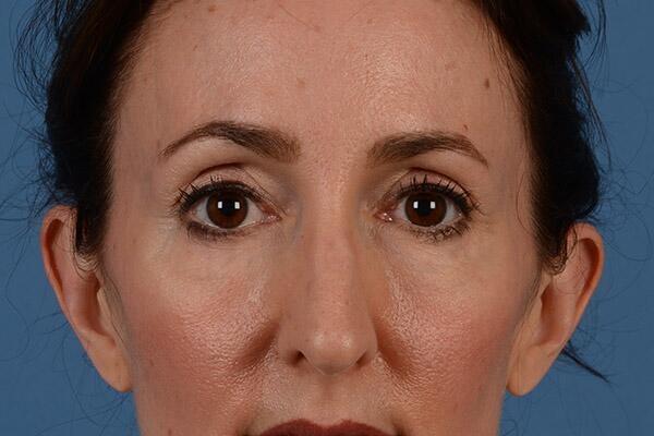 StarkMD Plastic Surgery & Aesthetic Center eyelid lift after — Bryn Mawr, PA