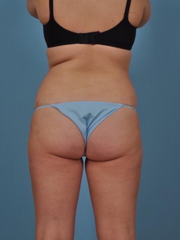Brazilian Butt Lift before at StarkMD Plastic Surgery & Aesthetic Center in Bryn Mawr, PA