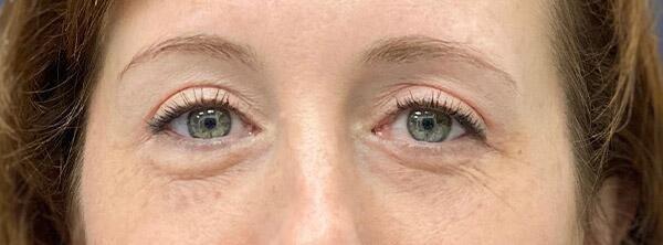 StarkMD Plastic Surgery & Aesthetic Center eyelid lift after — Bryn Mawr, PA