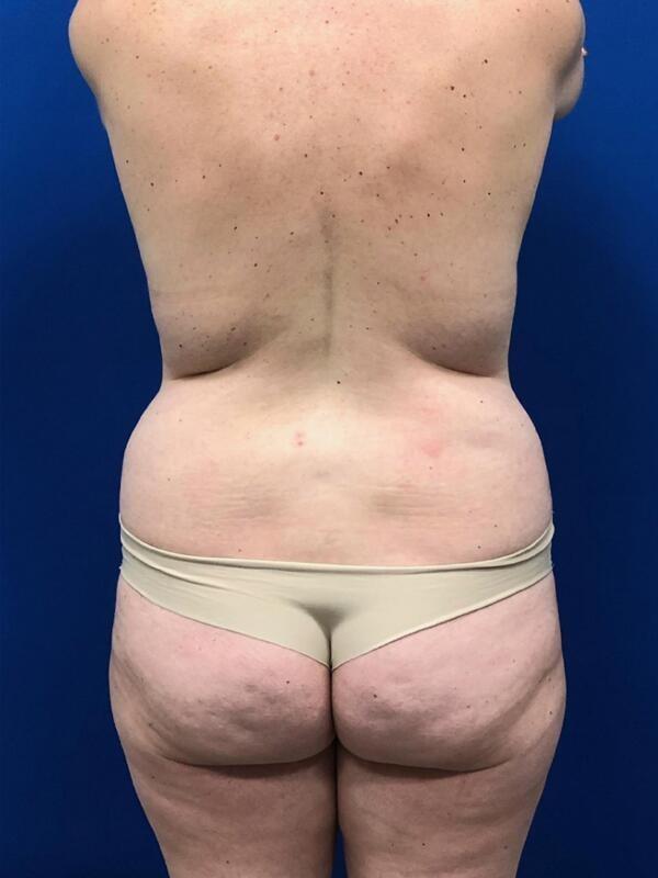 Brazilian Butt Lift before at StarkMD Plastic Surgery & Aesthetic Center in Bryn Mawr, PA