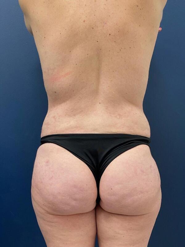 Brazilian Butt Lift after at StarkMD Plastic Surgery & Aesthetic Center in Bryn Mawr, PA