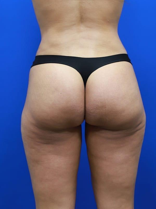 Brazilian Butt Lift after at StarkMD Plastic Surgery & Aesthetic Center in Bryn Mawr, PA