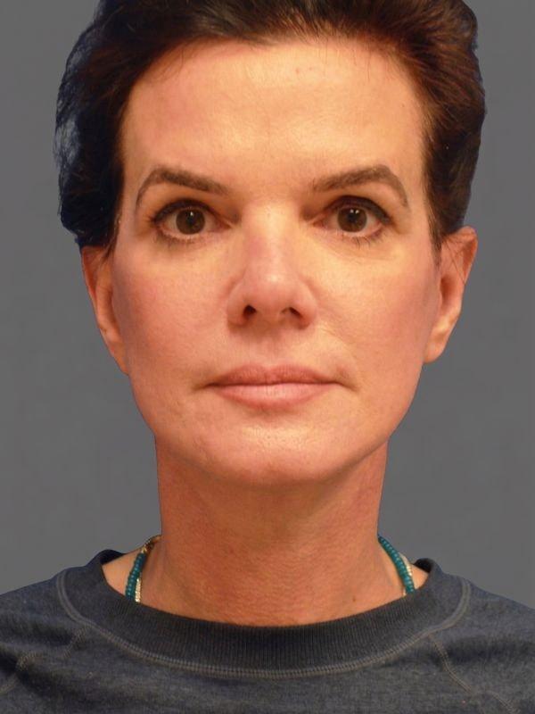 StarkMD Plastic Surgery & Aesthetic Center facelift after — Bryn Mawr, PA