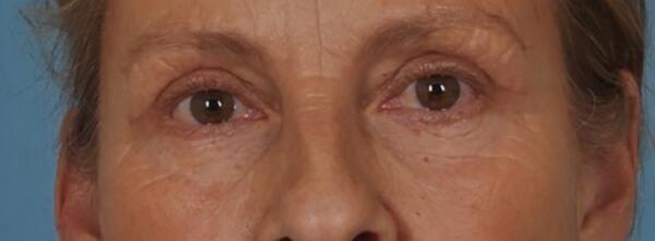 StarkMD Plastic Surgery & Aesthetic Center eyelid lift after — Bryn Mawr, PA