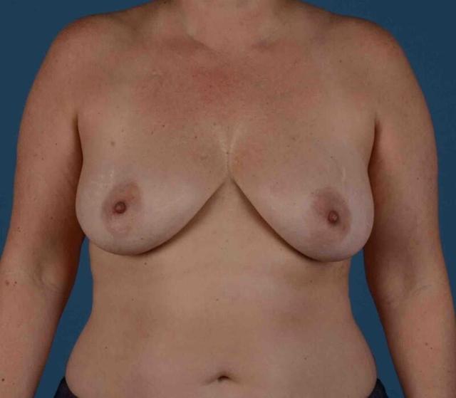 Breast Lift before at StarkMD Plastic Surgery & Aesthetic Center in Bryn Mawr, PA