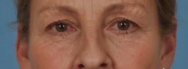 Blepharoplasty before at StarkMD Plastic Surgery & Aesthetic Center in Bryn Mawr, PA