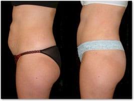 Salmon Creek Plastic Surgery tummy tuck result — Vancouver, WA