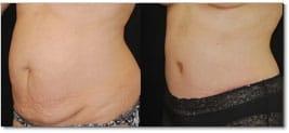 Salmon Creek Plastic Surgery tummy tuck result — Vancouver, WA