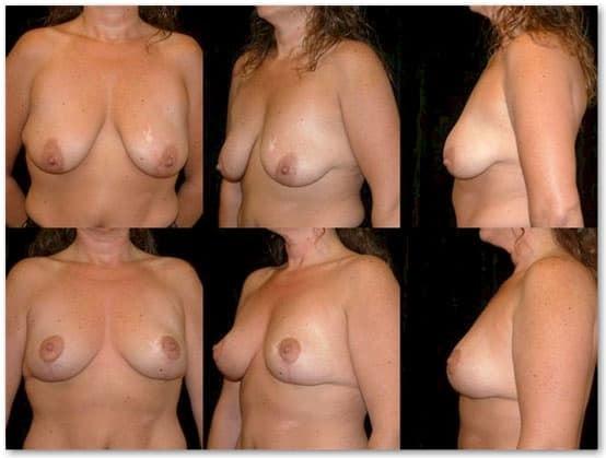 Salmon Creek Plastic Surgery breast lift result — Vancouver, WA