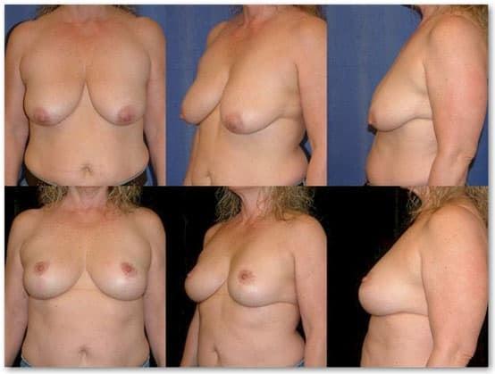 Salmon Creek Plastic Surgery breast lift result — Vancouver, WA