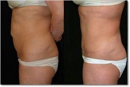 Salmon Creek Plastic Surgery tummy tuck result — Vancouver, WA