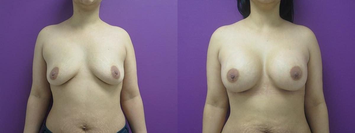 Town Plastic Surgery breast augmentation result — New York, NY