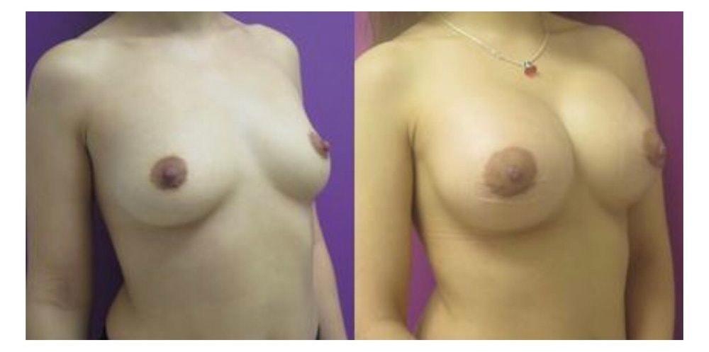 Town Plastic Surgery breast augmentation result — New York, NY