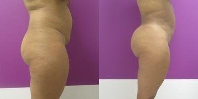 Town Plastic Surgery bbl result — New York, NY