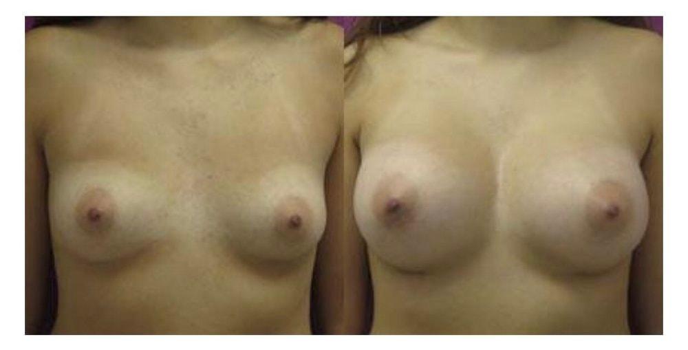 Town Plastic Surgery breast augmentation result — New York, NY