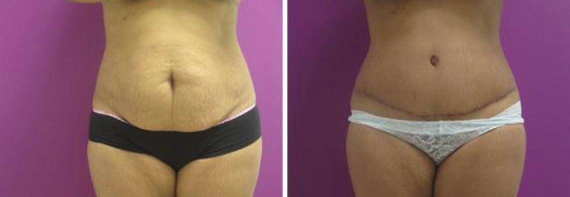 Town Plastic Surgery tummy tuck result — New York, NY