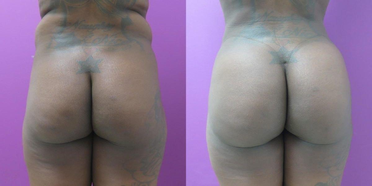 Town Plastic Surgery bbl result — New York, NY