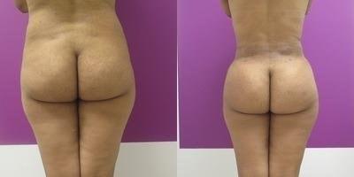 Town Plastic Surgery bbl result — New York, NY