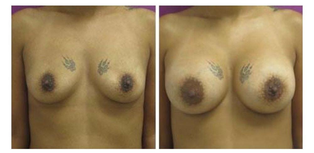Town Plastic Surgery breast augmentation result — New York, NY