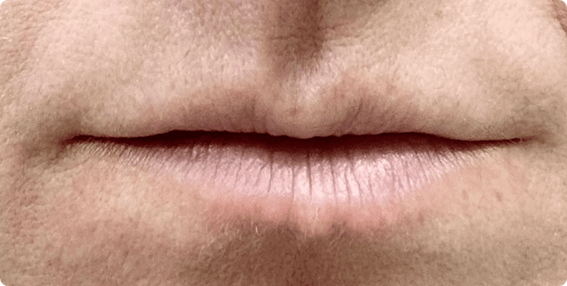 Lip Filler before at ABQ Medical Spa in Albuquerque, NM
