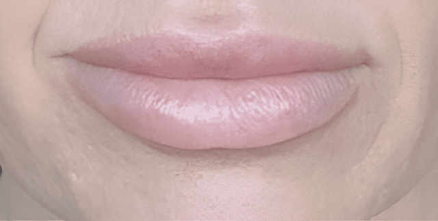 Lip Filler after at ABQ Medical Spa in Albuquerque, NM