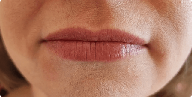 Lip Filler before at ABQ Medical Spa in Albuquerque, NM
